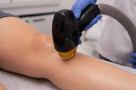 Laser epilation - hair removal procedure, diode laser technology on skin